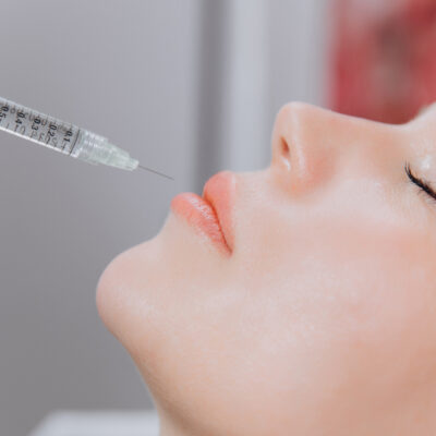 RESTYLANE® or VERSA® Smile Lines FDA Filler