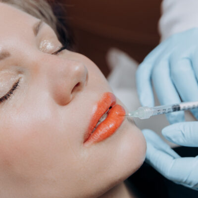 Revanesse® for LIPS Dermal Filler – Natural look