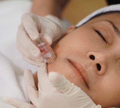 Rejuvenation Combo: with Belotero Balance Filler and 30 units of BOTOX