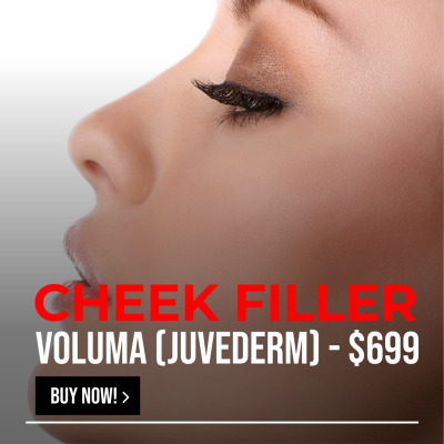 CHEEK FILLER - VOLUMA (JUVEDERM)