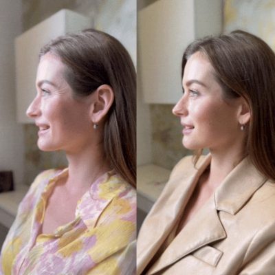 SMILE LINES REDUCTION - RESTYLANE