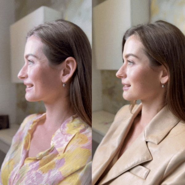 SMILE LINES REDUCTION - RESTYLANE