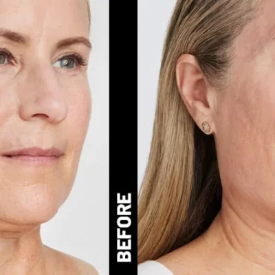 ULTHERAPY Non-Surgical FACE-LIFT
