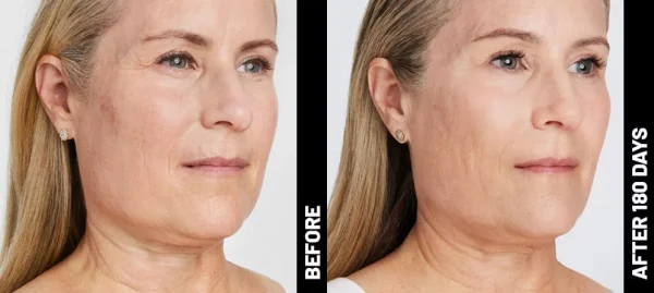 ULTHERAPY Non-Surgical FACE-LIFT