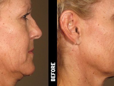 ULTHERAPY Non-Surgical UNDERCHIN-LIFT