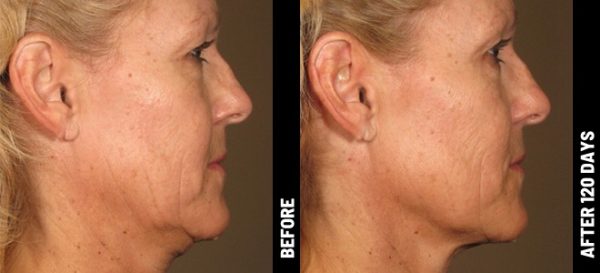 ULTHERAPY Non-Surgical UNDERCHIN-LIFT