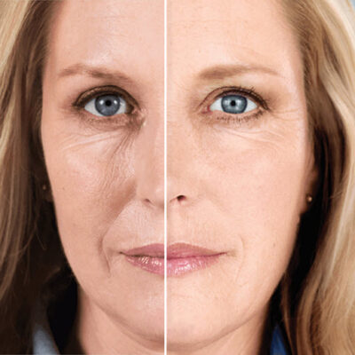 Sculptra Facial
